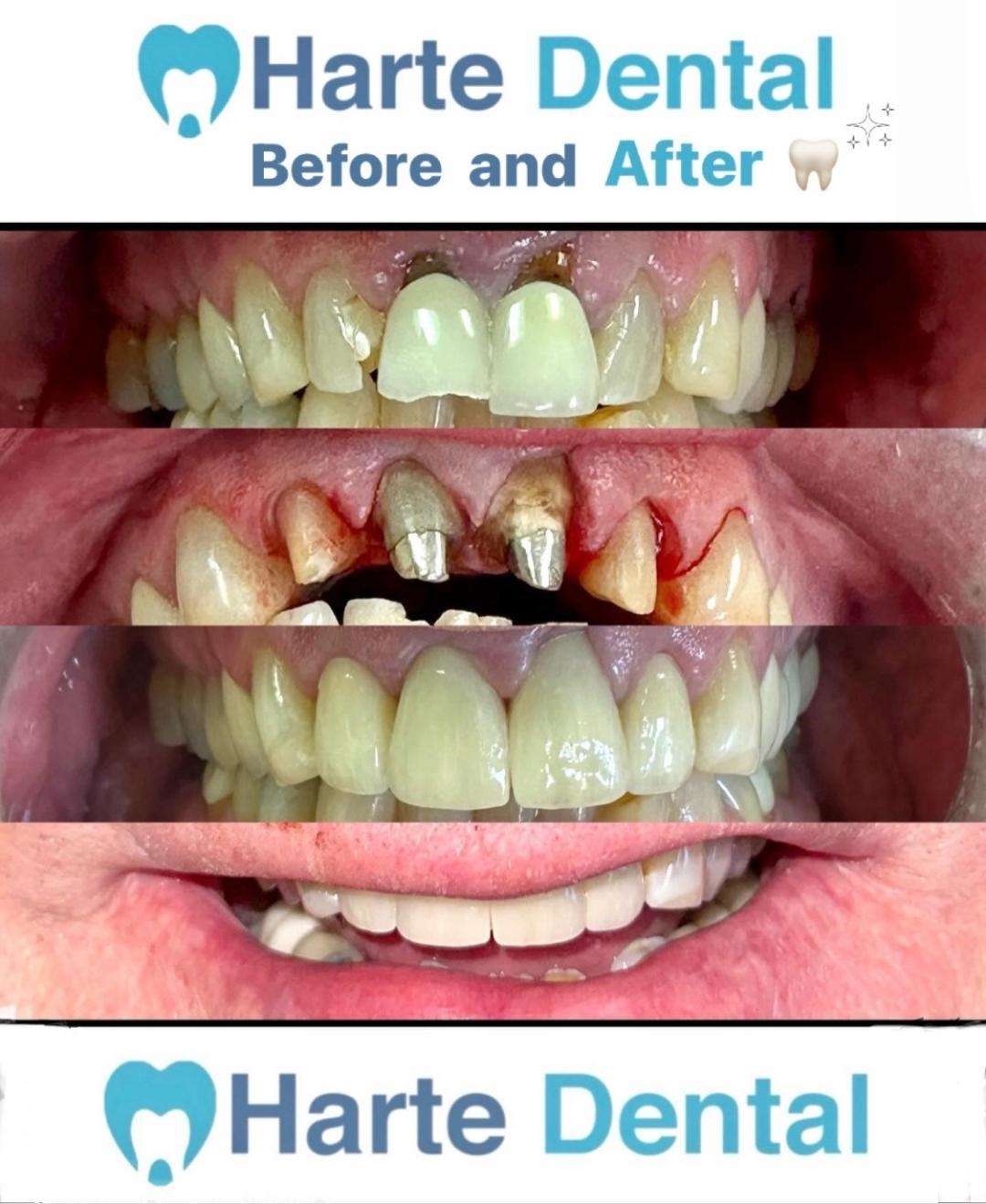 Harte Dental Crowns to the Rescue! Dental Implants Milton MA