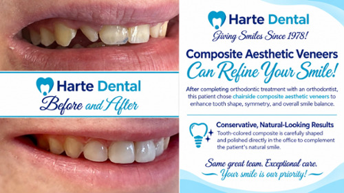 Image of before and after composite aesthetic veneers at harte dental in milton ma