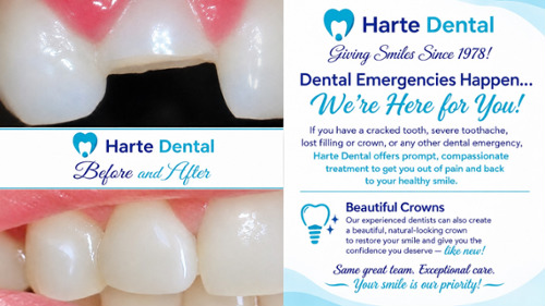 Before and After image at Harte Dental - emergency crown treatment