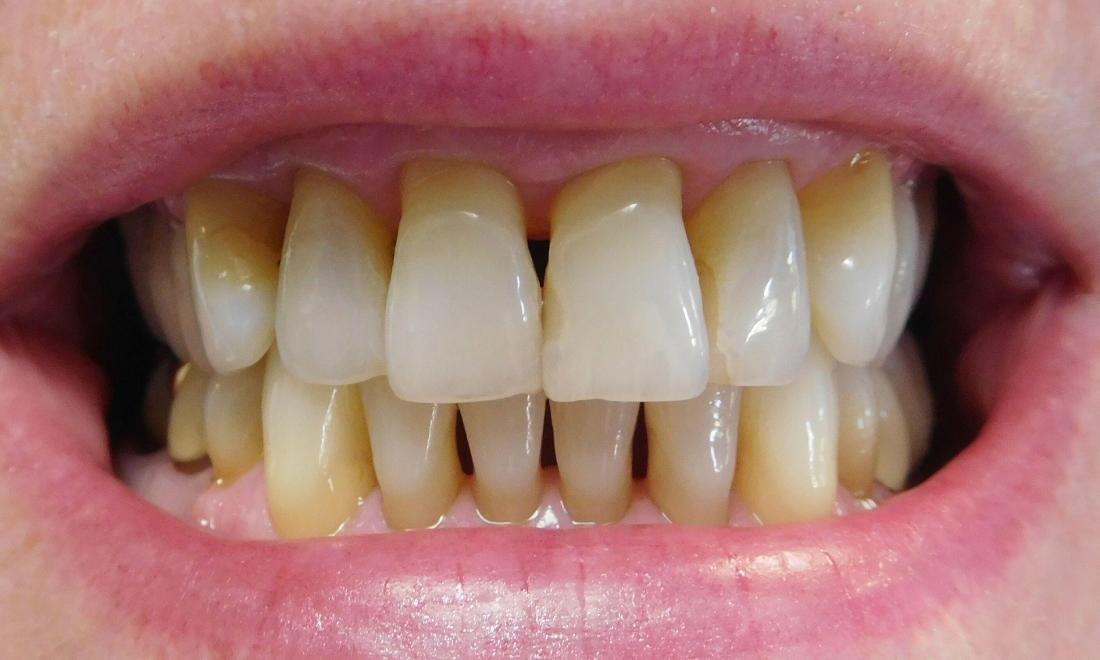 Dental Bonding Before & After Photos Milton MA