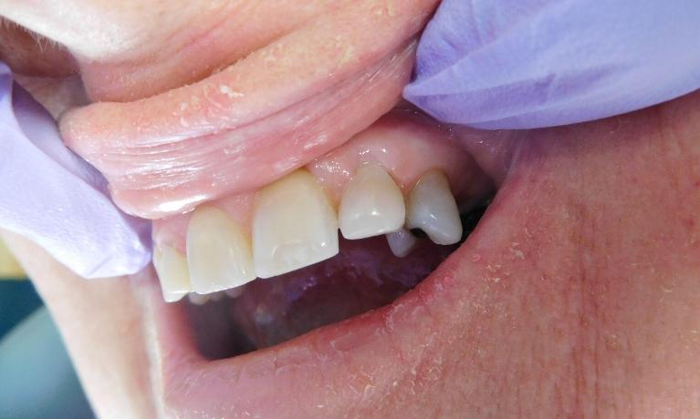 Dental-Bonding-After-Image