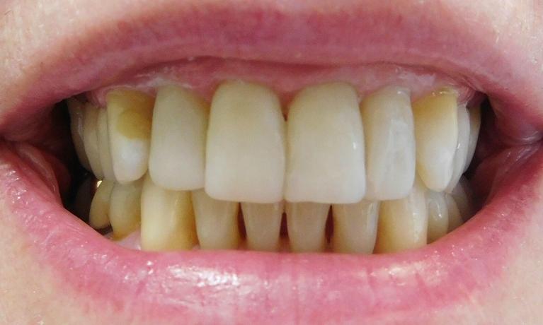 Dental-Bonding-After-Image