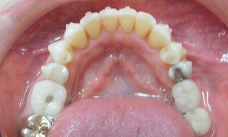 Invisalign-After-Image