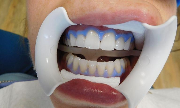 Teeth-Whitening-After-Image