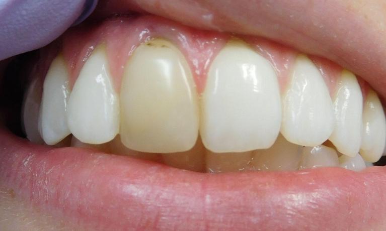 Crown-Before-Image