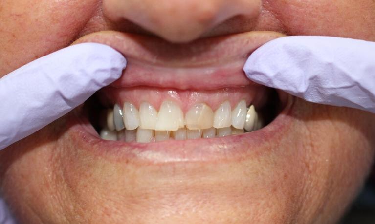 Crowns-Before-Image