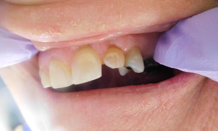 Dental-Bonding-Before-Image