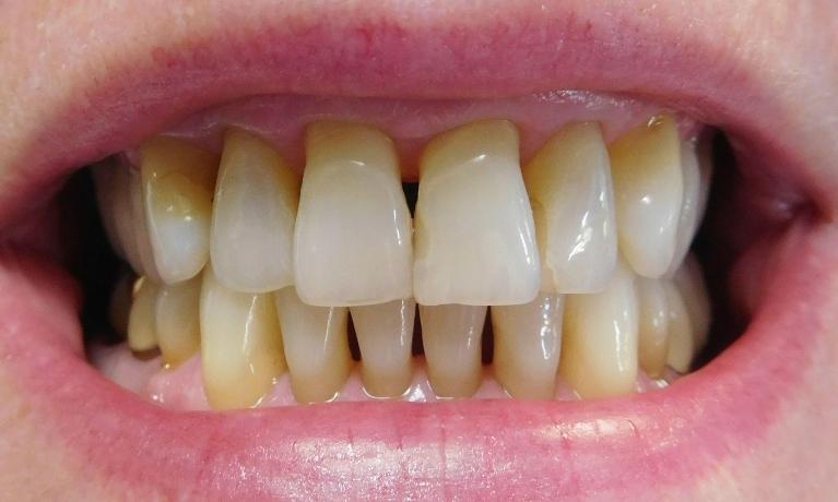 Dental-Bonding-Before-Image