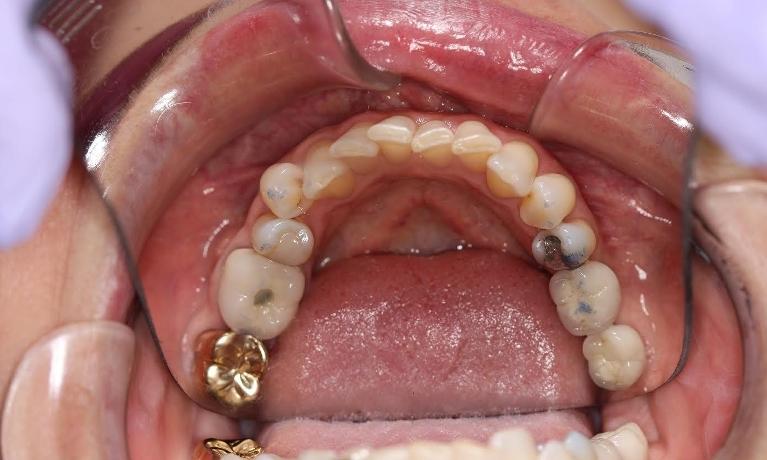 Invisalign-Before-Image