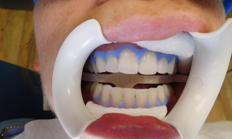 Teeth-Whitening-Before-Image