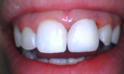Harte Dental after picture of dental crown that is white and healthy Milton MA
